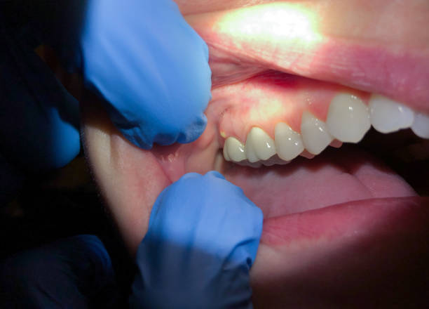 Best Emergency Broken Tooth Repair in Somers Point, NJ